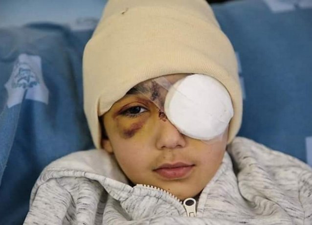8-летний палестинец, раненый израильскими солдатами, потерял левый глаз